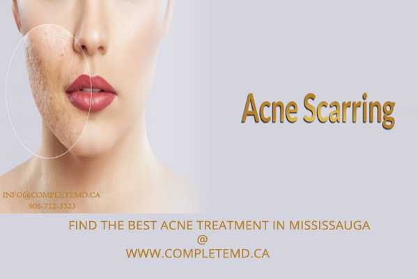 Find the best Acne Treatment in Mississauga at WWW.COMPLETEMD.CA